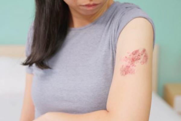 A young woman looks down at shingles rashes on her left arm. A bed and nightstand are in the background, slightly out of focus.